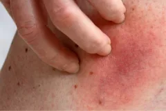 expert bed bug exterminator services health risk