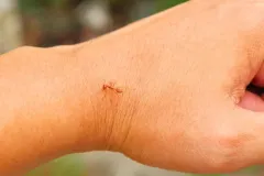 professional fire ant control near me health risk