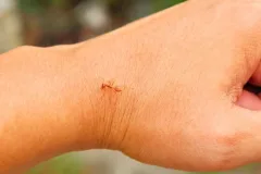 professional fire ant control near me health risk